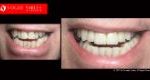 Cosmetic Dentistry Treatment Results Gallery closeup photos - Vogue Smiles Dental Dentistry Melbourne Studios Clinic Practice