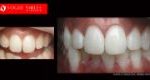 Cosmetic Dentistry Treatment Results Gallery closeup photos - Vogue Smiles Dental Dentistry Melbourne Studios Clinic Practice