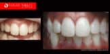 Cosmetic Dentistry Treatment Results Gallery closeup photos - Vogue Smiles Dental Dentistry Melbourne Studios Clinic Practice