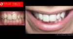 Cosmetic Dentistry Treatment Results Gallery closeup photos - Vogue Smiles Dental Dentistry Melbourne Studios Clinic Practice