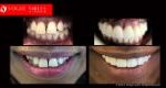 Full Mouth Reconstruction & Rehabilitation BEFORE AND AFTER, Close-up dental Photos Before and After, Affordable Cosmetic Dentist NEAR ME Melbourne Before and After, Improve Smiles Before and After