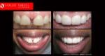 Full Mouth Reconstruction & Rehabilitation BEFORE AND AFTER, Close-up dental Photos Before and After, Affordable Cosmetic Dentist NEAR ME Melbourne Before and After, Improve Smiles Before and After