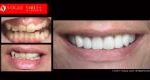 Full Mouth Reconstruction & Rehabilitation BEFORE AND AFTER, Close-up dental Photos Before and After, Affordable Cosmetic Dentist NEAR ME Melbourne Before and After, Improve Smiles Before and After