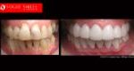 Full Mouth Reconstruction & Rehabilitation BEFORE AND AFTER, Close-up dental Photos Before and After, Affordable Cosmetic Dentist NEAR ME Melbourne Before and After, Improve Smiles Before and After