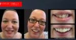 Affordable Cosmetic Dentistry Before & After - SNAP ON SMILE MELBOURNE AUSTRALIA