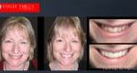 Affordable Cosmetic Dentistry Before & After - SNAP ON SMILE MELBOURNE AUSTRALIA