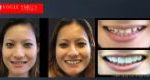 Affordable Cosmetic Dentistry Before & After - SNAP ON SMILE MELBOURNE AUSTRALIA