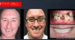 Affordable Cosmetic Dentistry Before & After - SNAP ON SMILE MELBOURNE AUSTRALIA