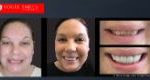 Affordable Cosmetic Dentistry Before & After - SNAP ON SMILE MELBOURNE AUSTRALIA