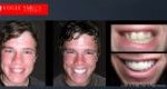 Affordable Cosmetic Dentistry Before & After - SNAP ON SMILE MELBOURNE AUSTRALIA