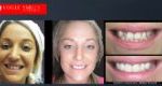 Crooked Teeth Before and After Photos - Smile Gallery Melbourne CBD -VOGUE SMILES MELBOURNE