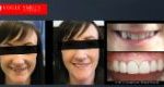 Crooked Teeth Before and After Photos - Smile Gallery Melbourne CBD -VOGUE SMILES MELBOURNE