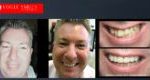 Affordable Porcelain Dental Crowns in Melbourne Before and After, Dental Bridges in Melbourne Before and After, Dental Crowns and Dental Bridges Melbourne CBD Before and After