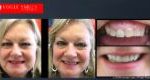 Porcelain Veneers Before and After | Veneers Smile Gallery Melbourne CBD