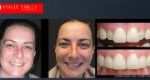 Porcelain Veneers Before and After | Veneers Smile Gallery Melbourne CBD