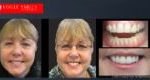 Porcelain Veneers Before and After | Veneers Smile Gallery Melbourne CBD