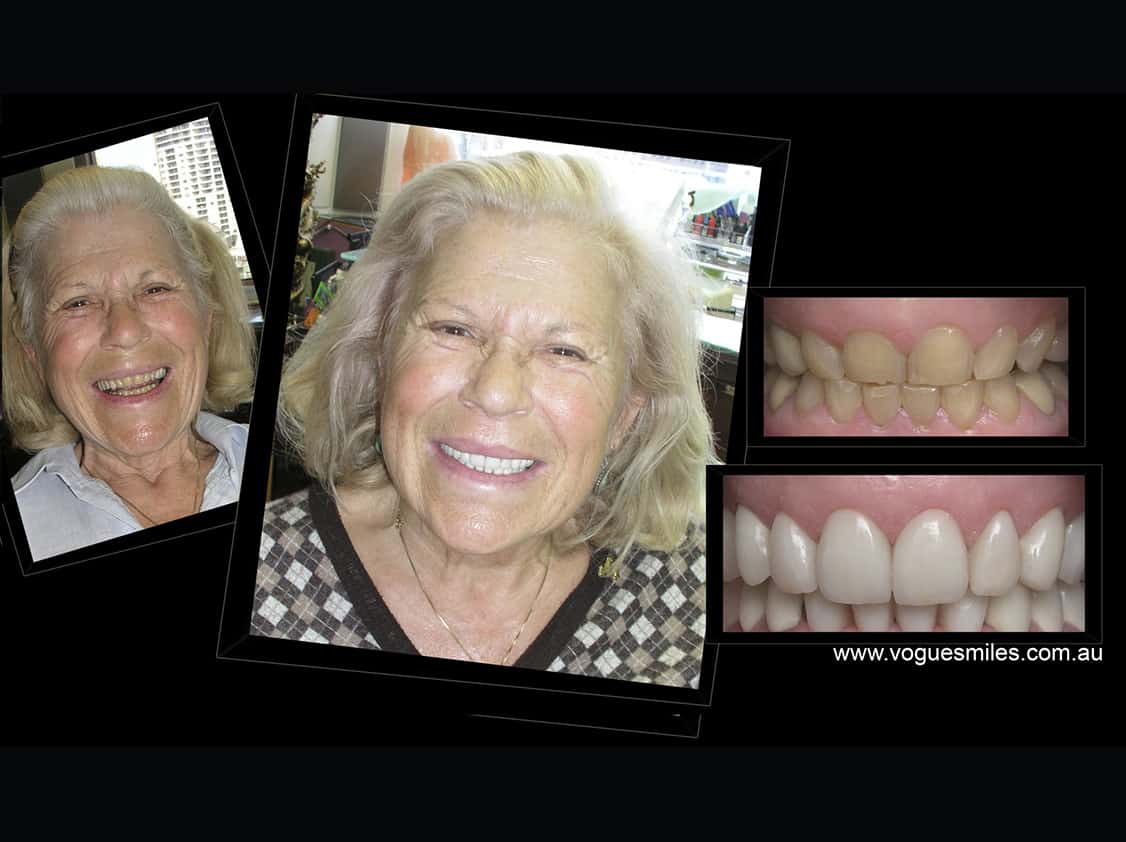 Worn Down Teeth Repair Treatment in Nowra NSW