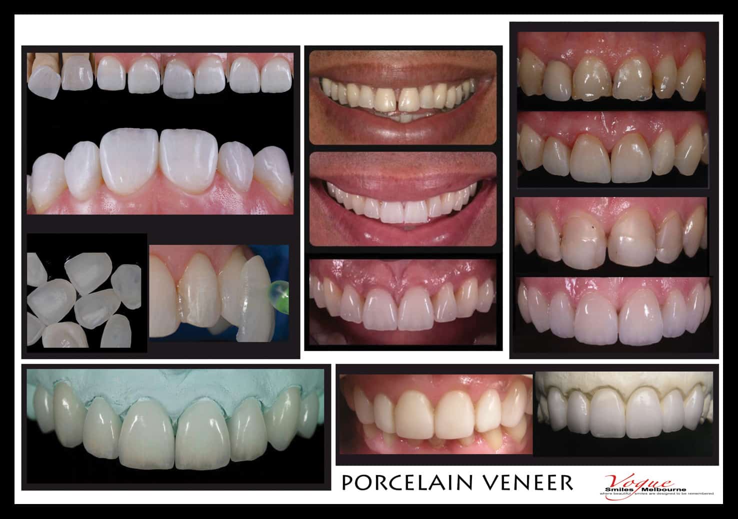 Beautiful Smiles with Lumineers Veneers Melbourne CBD | Dental Veneers Melbourne