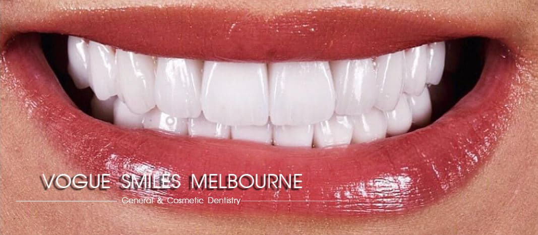 Who are not a good candidate for Dental Veneers