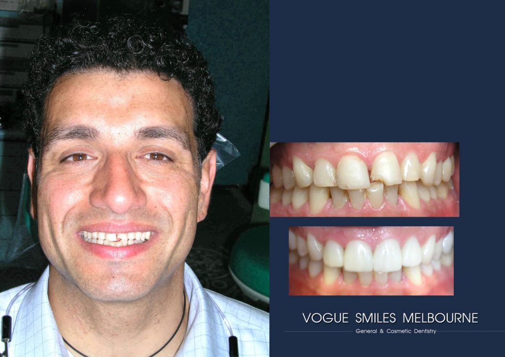 Lumineers vs Traditional Veneers - Differences, Pros, Cons and Cost