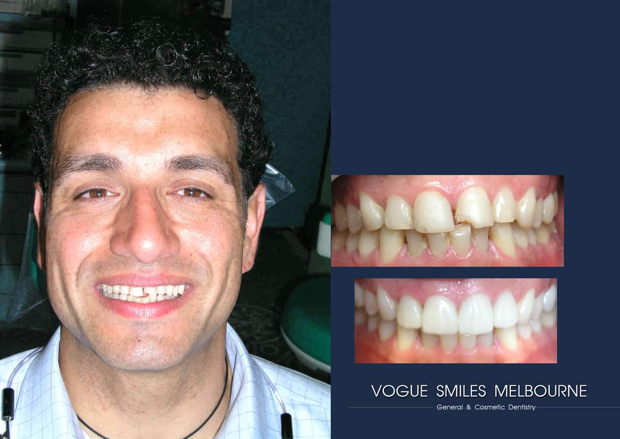 Beautiful Smiles with Lumineers Veneers Melbourne CBD | Dental Veneers Melbourne