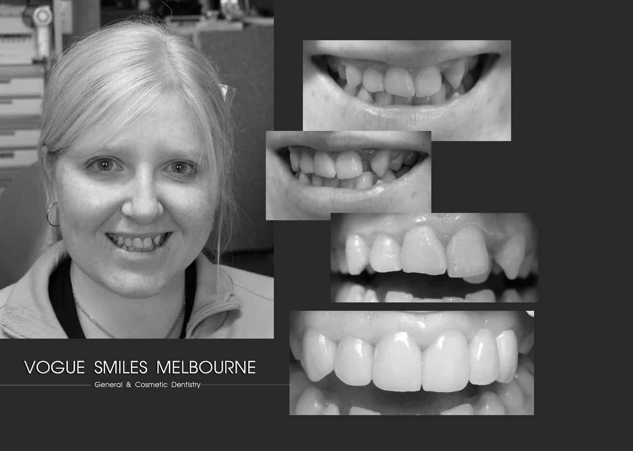 Teeth Straightening without braces Fast way Melbourne CBD City 3000 Victoria Australia, Affordable Teeth Straightening near me Dentist Melbourne, Instant Orthodontics Melbourne