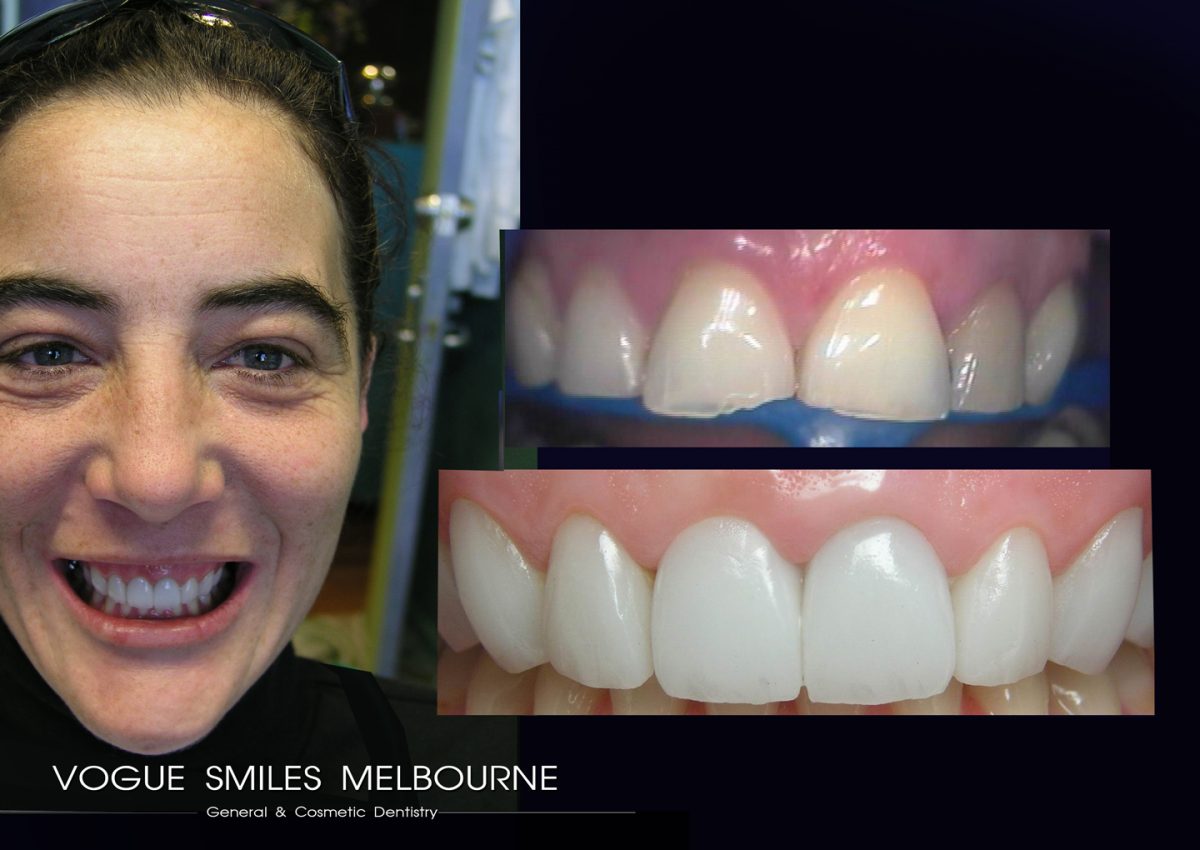 LUMINEERS VENEER versus TRADITIONAL PORCELAIN VENEER IN MELBOURNE