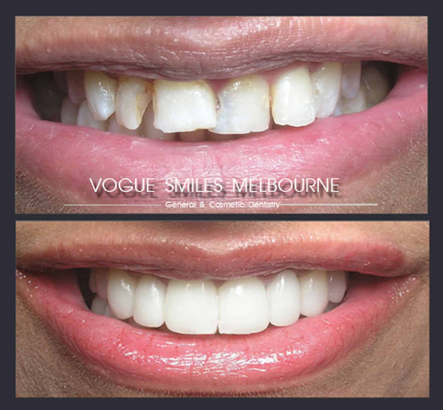 Instantly straighten Crooked teeth and bad bite without Braces or Invisalign with Porcelain Veneer