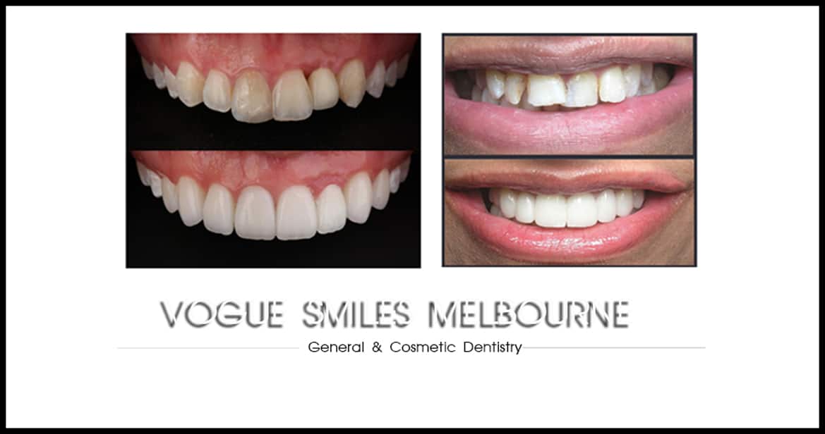 Costs of Cosmetic Dentistry and Smile Makeover in Melbourne 2023