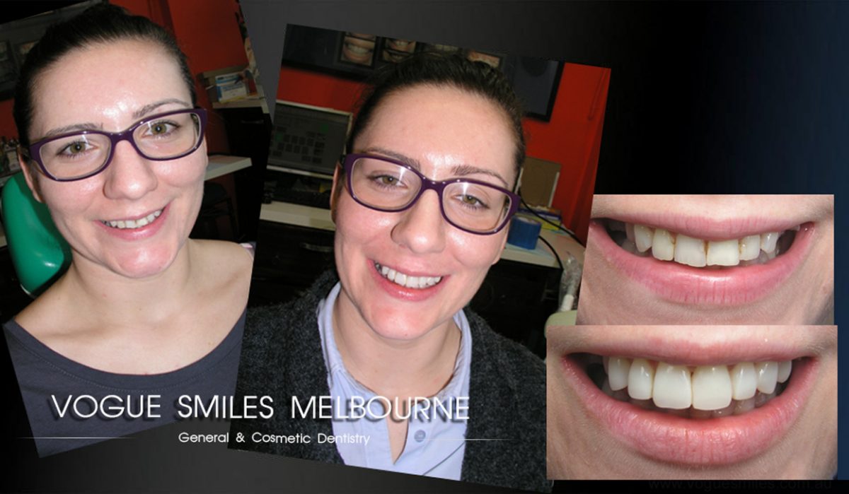 Cosmetic Tooth Bonding Melbourne