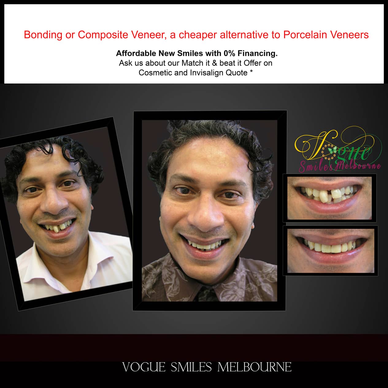 Dental Bonding Melbourne CBD, Composite Resin Bonding Melbourne City CBD , Composite Veneers Melbourne CBD -Composite Dental Bonding - Affordable Smile Makeover Procedure Affordable Cosmetic Dentist Melbourne CBD