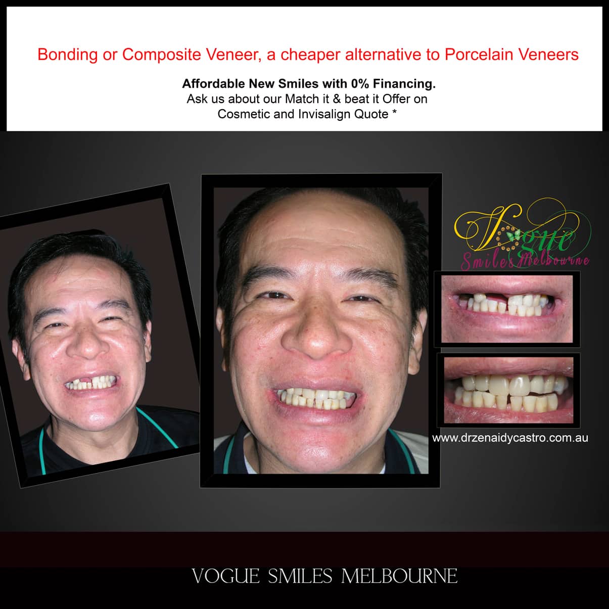 Dental Bonding Melbourne CBD, Composite Resin Bonding Melbourne City CBD , Composite Veneers Melbourne CBD -Composite Dental Bonding - Affordable Smile Makeover Procedure Affordable Cosmetic Dentist Melbourne CBD