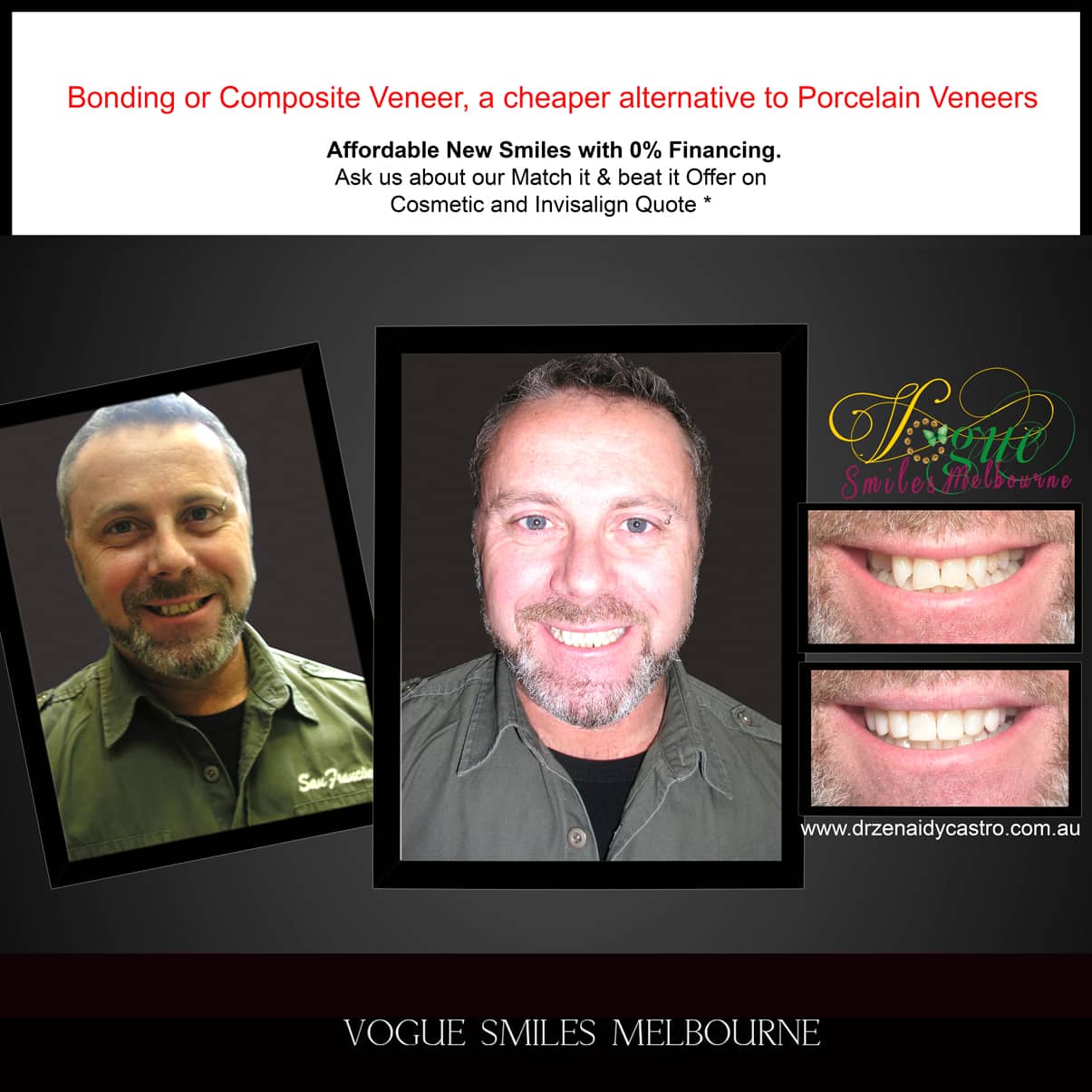 Dental Bonding Melbourne CBD, Composite Resin Bonding Melbourne City CBD , Composite Veneers Melbourne CBD -Composite Dental Bonding - Affordable Smile Makeover Procedure Affordable Cosmetic Dentist Melbourne CBD