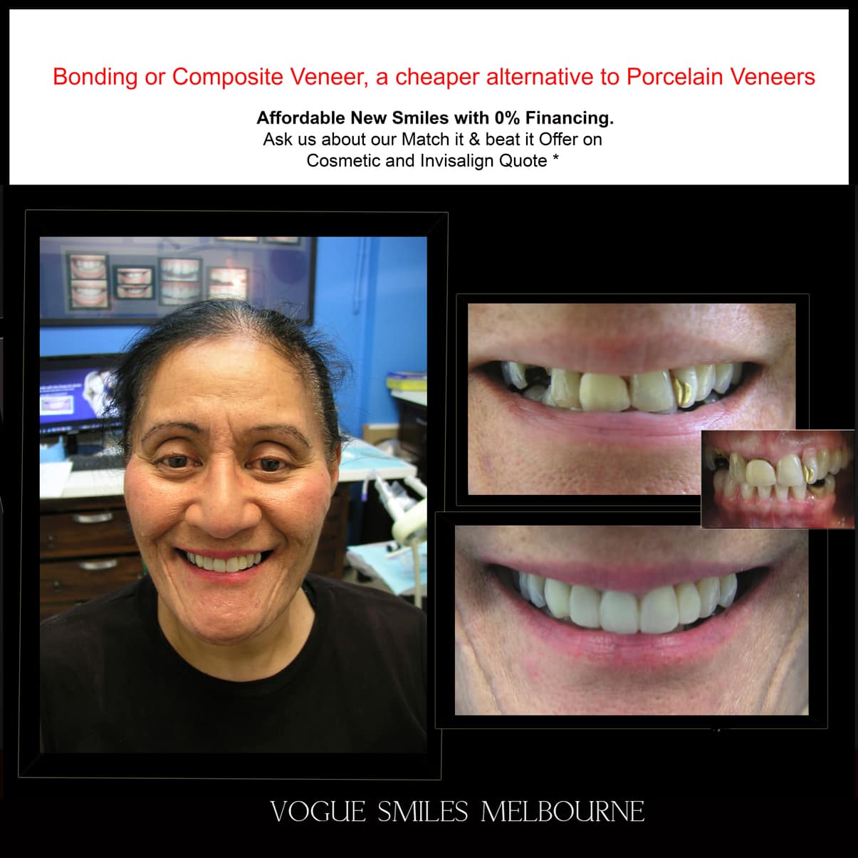 Dental Bonding Melbourne CBD, Composite Resin Bonding Melbourne City CBD , Composite Veneers Melbourne CBD -Composite Dental Bonding - Affordable Smile Makeover Procedure Affordable Cosmetic Dentist Melbourne CBD