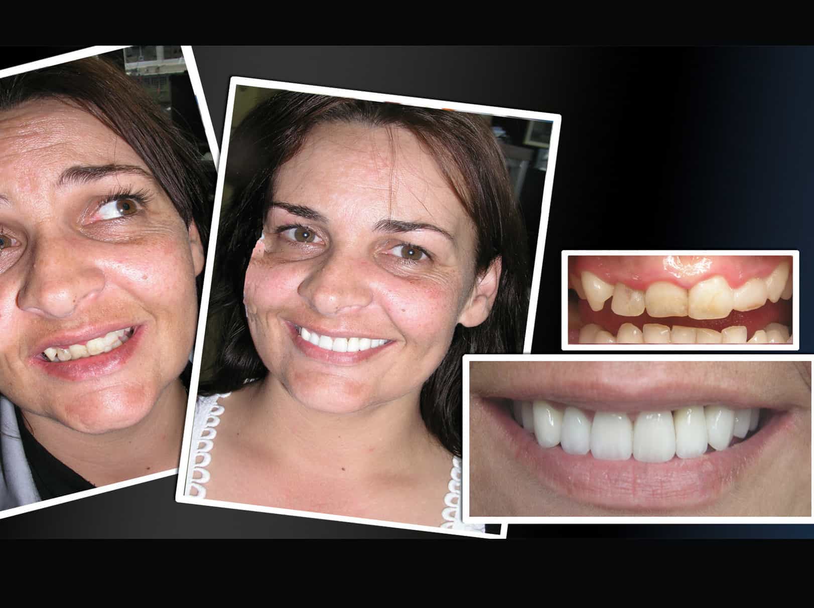 Permanent Teeth Whitening Treatment With Porcelain Veneers- MELBOURNE CBD COSMETIC DENTIST 