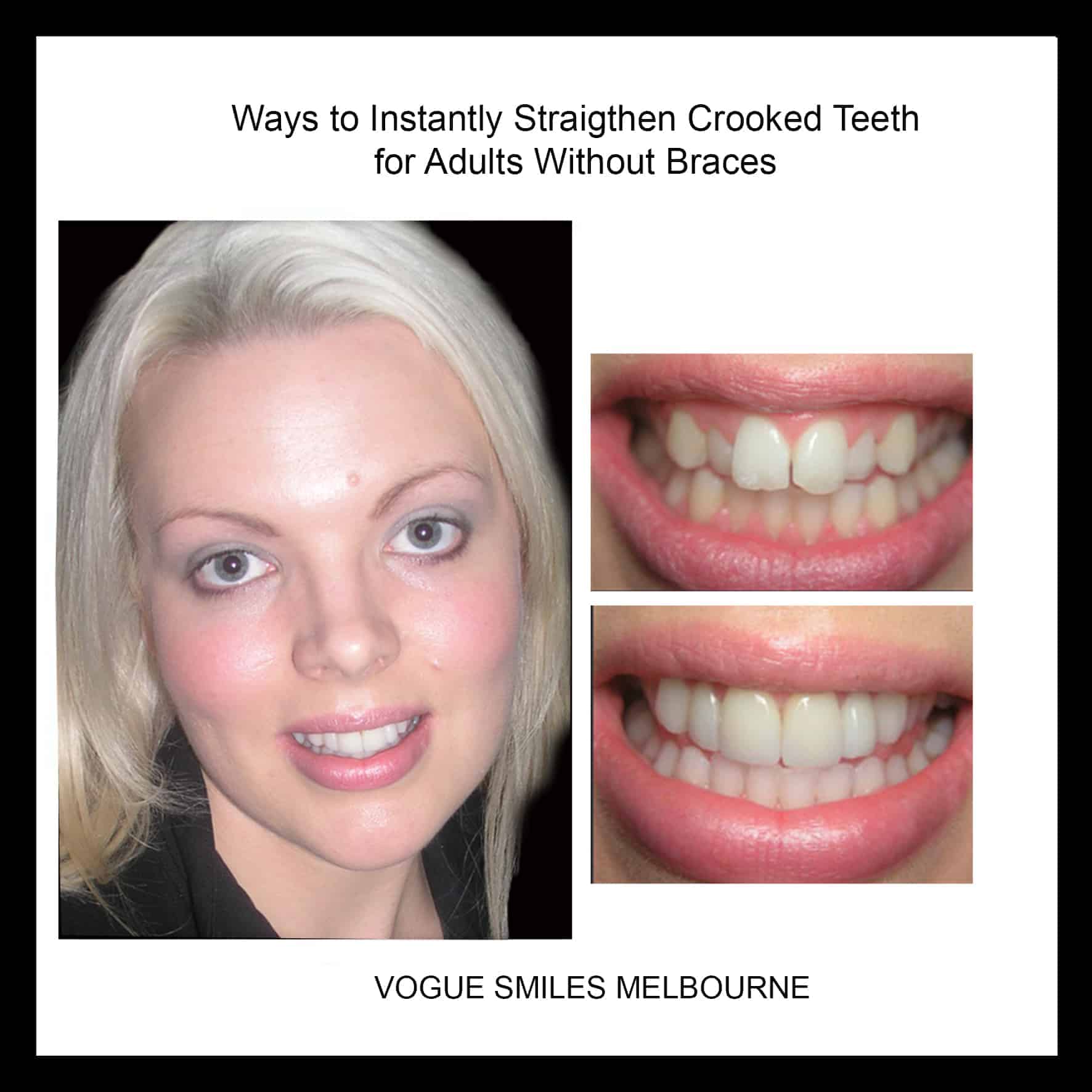 zoom whitening cost near me zoom whitening cost near me