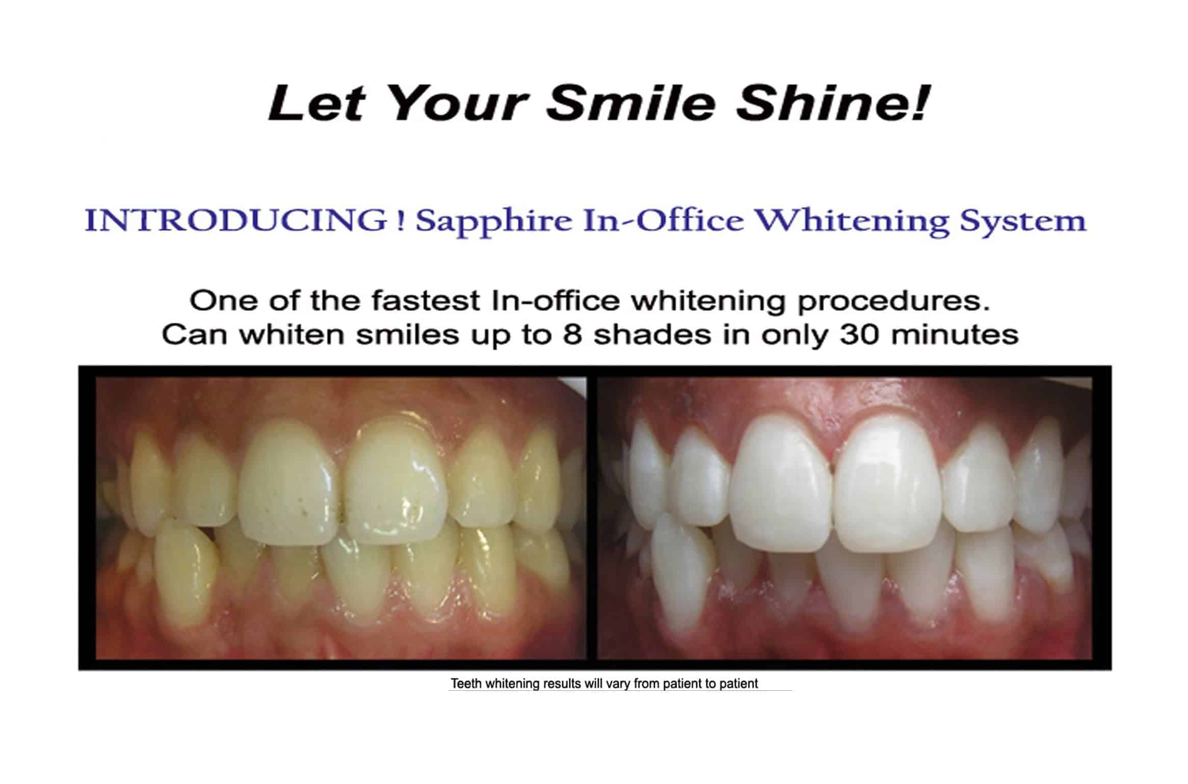 Teeth Whitening Cost and FAQs - How Much Does Teeth Whitening Cost In Melbourne?
