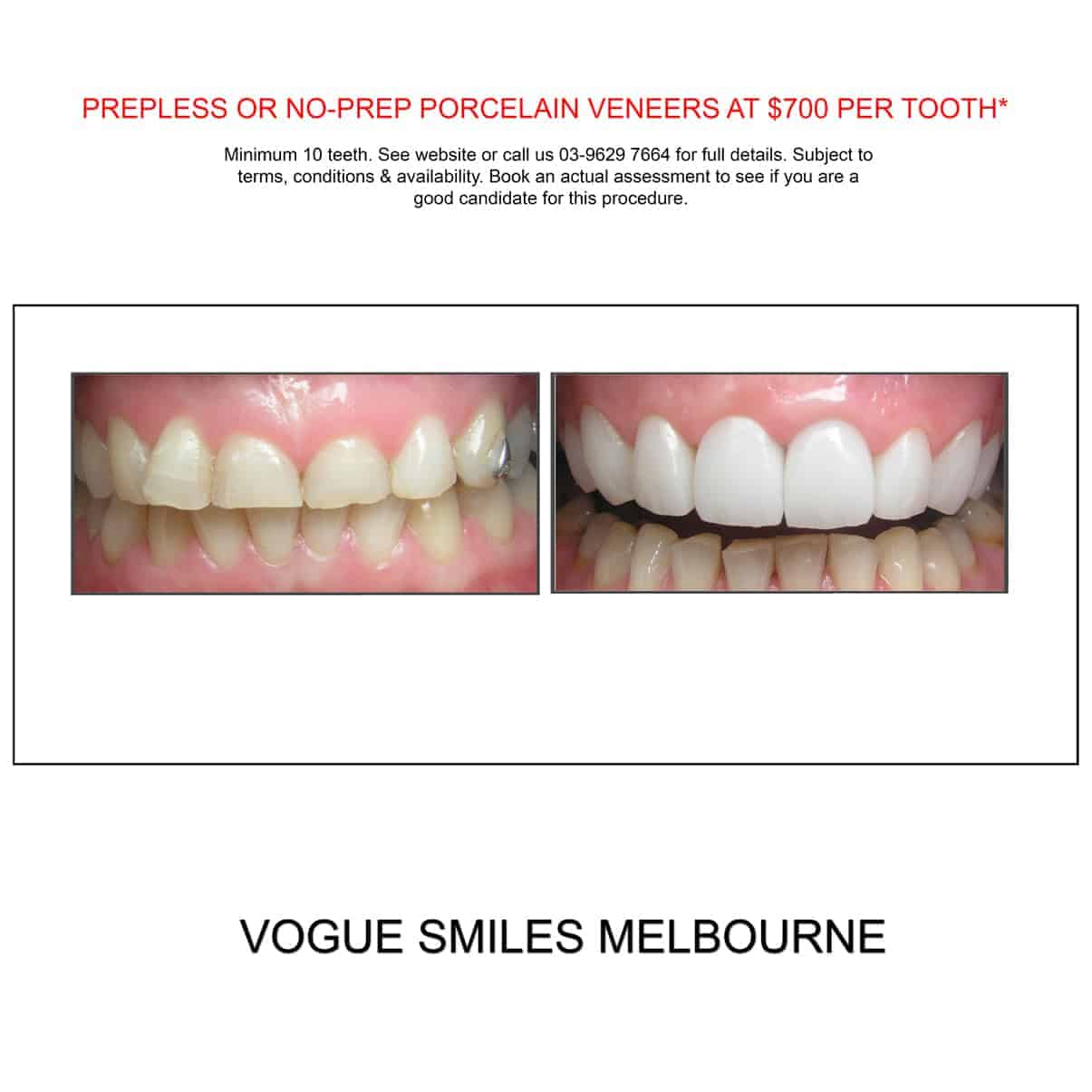  How Much Does Cosmetic Dental Work Cost in Melbourne?