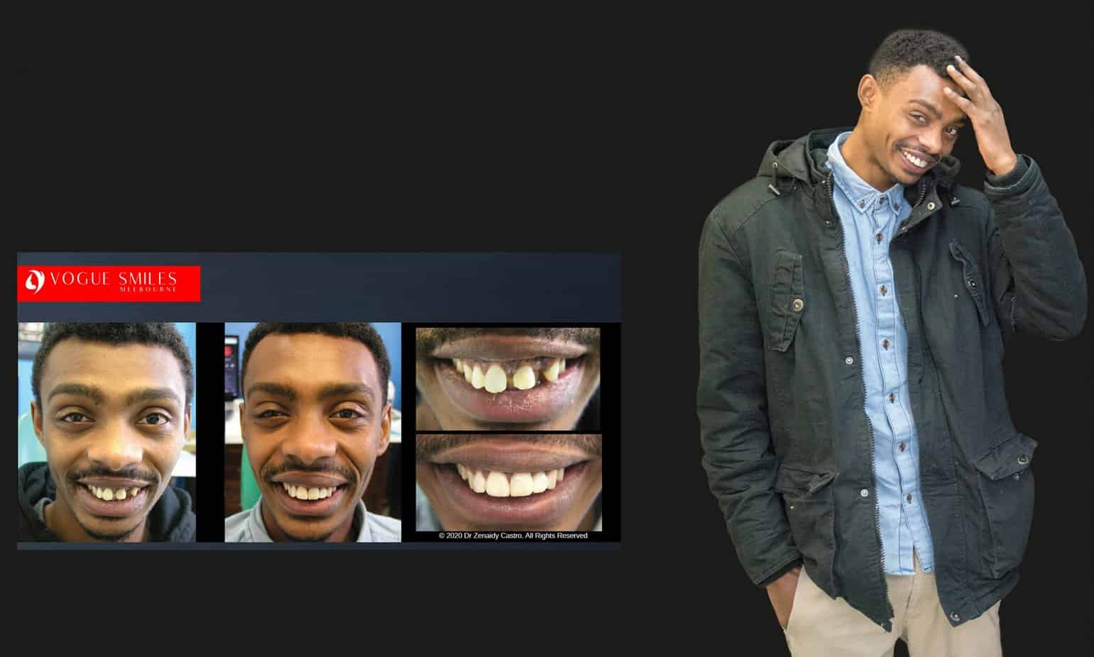 Composite Veneers | Resin Bonding Teeth | Teeth Veneers Melbourne Composite Veneers | Resin Bonding Teeth | Teeth Veneers Melbourne