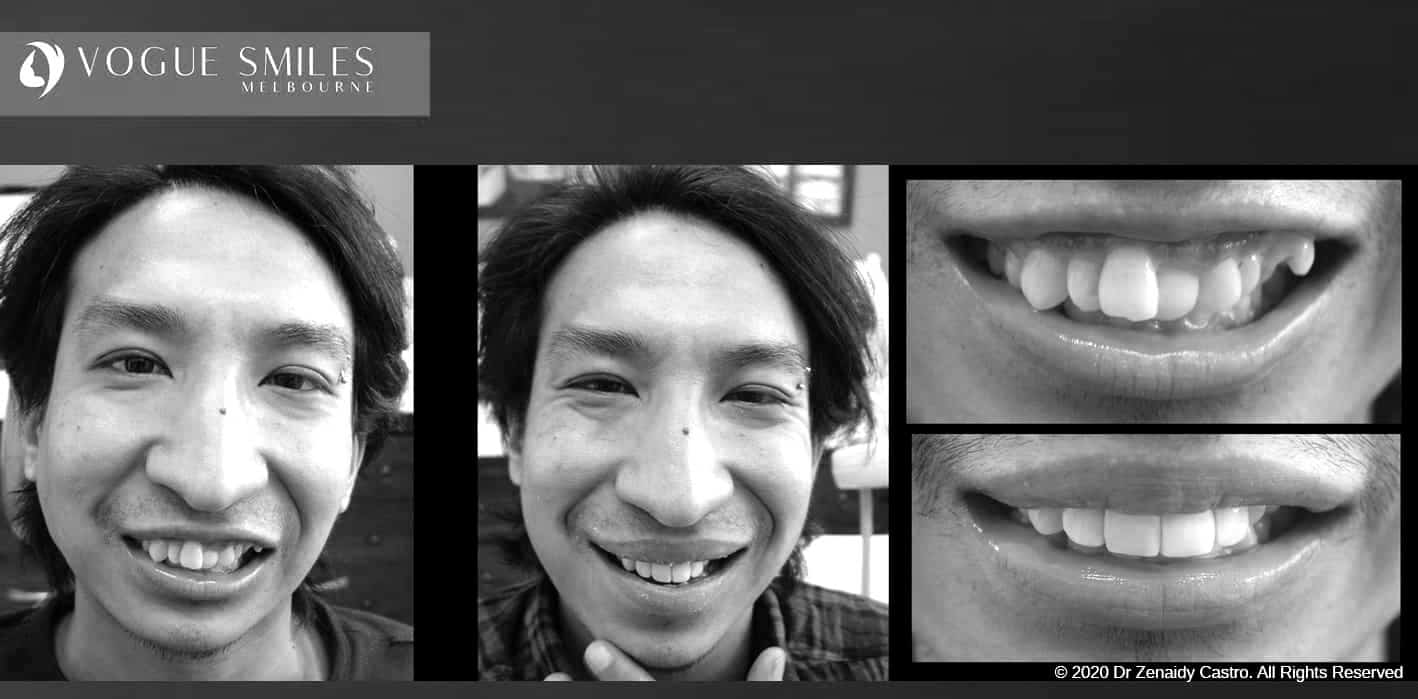 Composite Veneers | Resin Bonding Teeth | Teeth Veneers Melbourne Composite Veneers | Resin Bonding Teeth | Teeth Veneers Melbourne