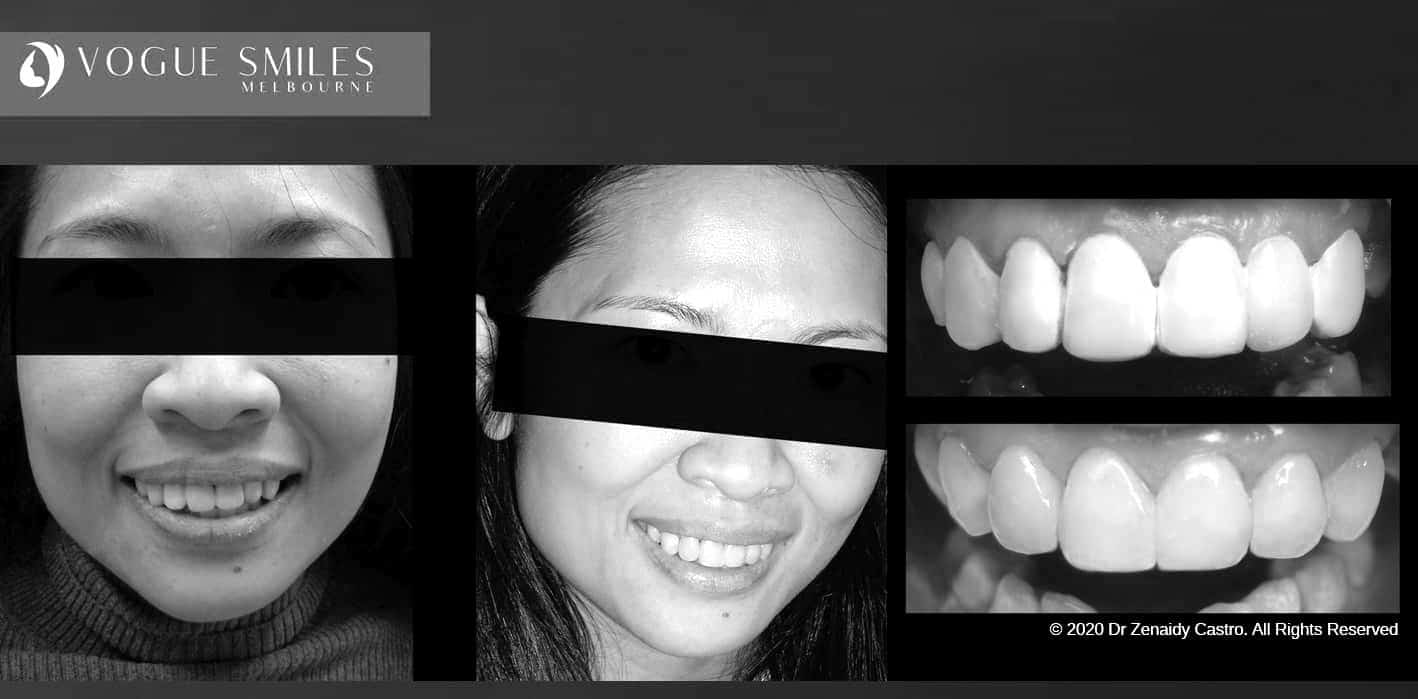 Composite Veneers | Resin Bonding Teeth | Teeth Veneers Melbourne