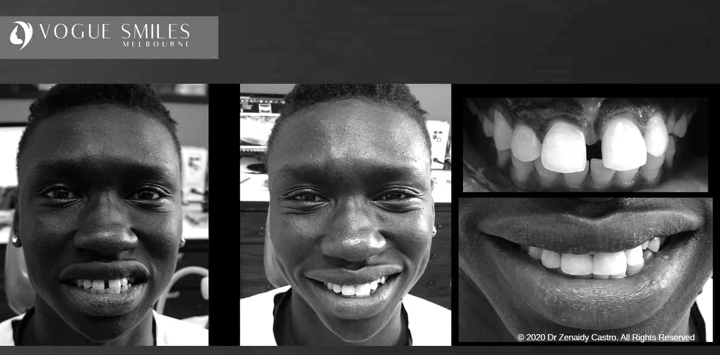 Composite Veneers | Resin Bonding Teeth | Teeth Veneers Melbourne Composite Veneers | Resin Bonding Teeth | Teeth Veneers Melbourne
