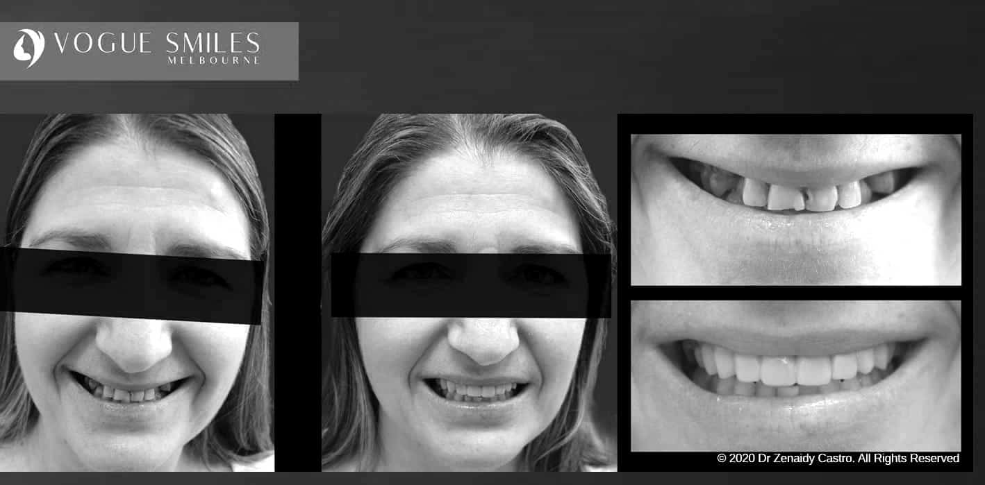 Composite Veneers | Resin Bonding Teeth | Teeth Veneers Melbourne Composite Veneers | Resin Bonding Teeth | Teeth Veneers Melbourne