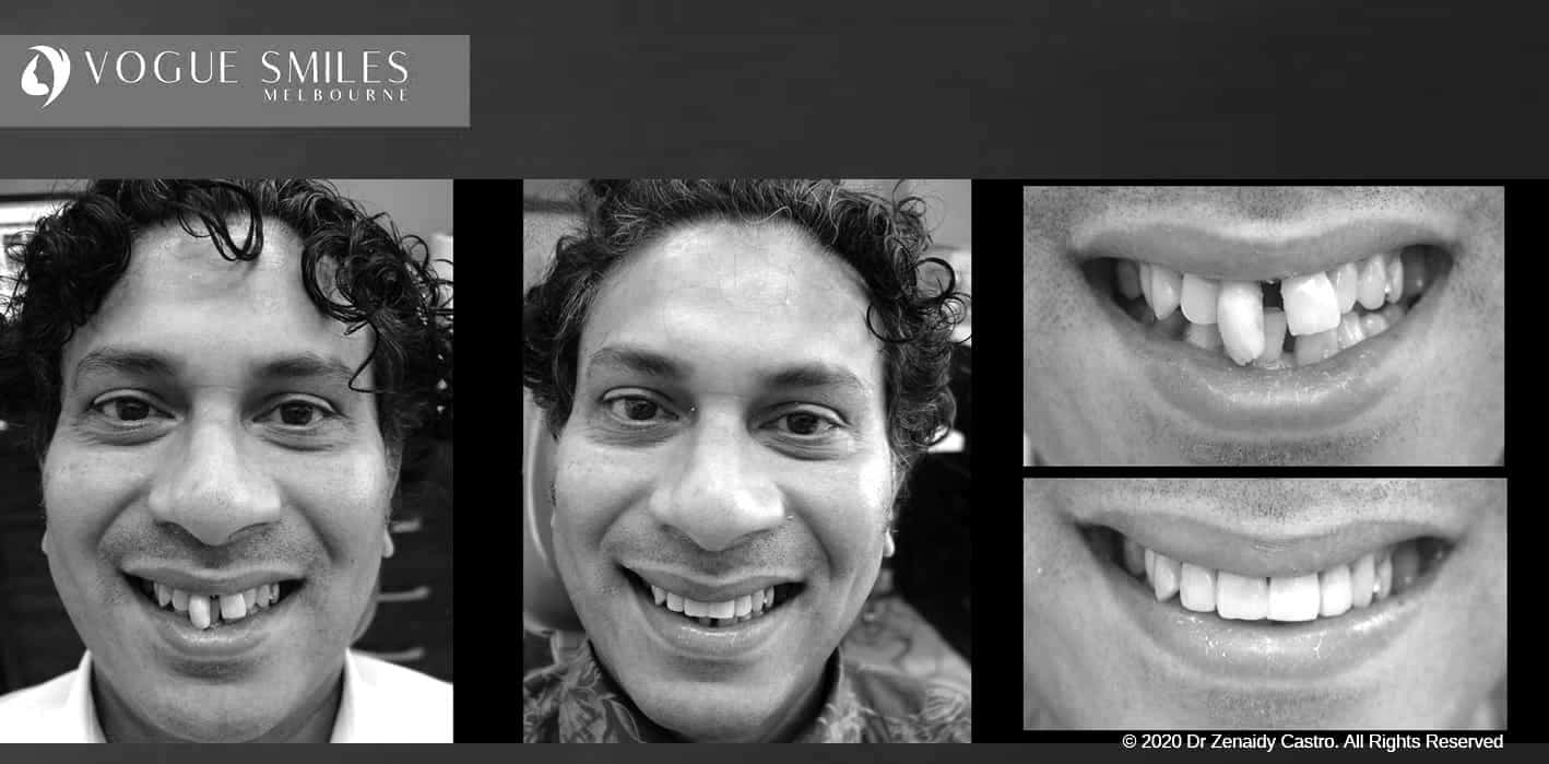 Composite Veneers - Resin Bonding- Teeth Teeth Veneers Melbourne -VOGUE SMILES MELBOURNE Composite Veneers - Resin Bonding- Teeth Teeth Veneers Melbourne -VOGUE SMILES MELBOURNE