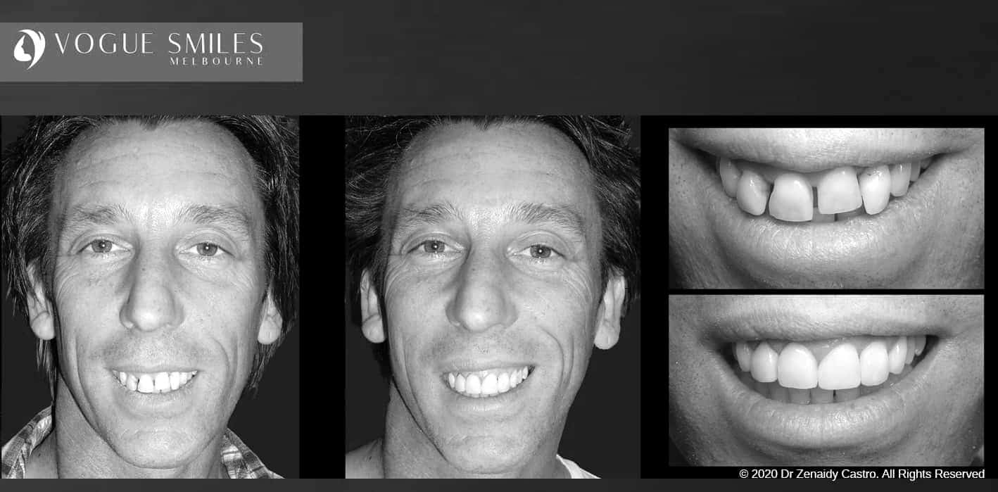 Composite Veneers | Resin Bonding Teeth | Teeth Veneers Melbourne Composite Veneers | Resin Bonding Teeth | Teeth Veneers Melbourne