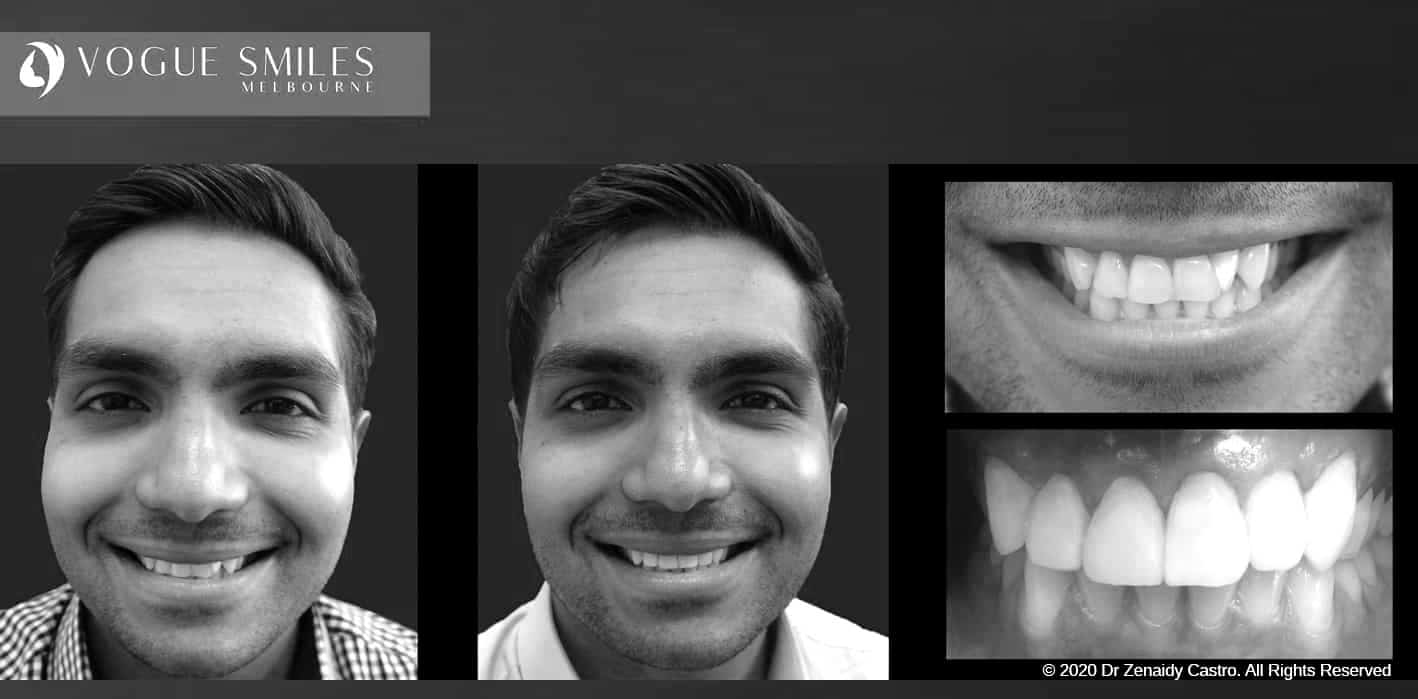 Composite Veneers - Resin Bonding- Teeth Teeth Veneers Melbourne -VOGUE SMILES MELBOURNE Composite Veneers - Resin Bonding- Teeth Teeth Veneers Melbourne -VOGUE SMILES MELBOURNE