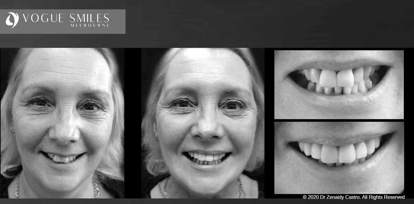 Composite Veneers | Resin Bonding Teeth | Teeth Veneers Melbourne Composite Veneers | Resin Bonding Teeth | Teeth Veneers Melbourne