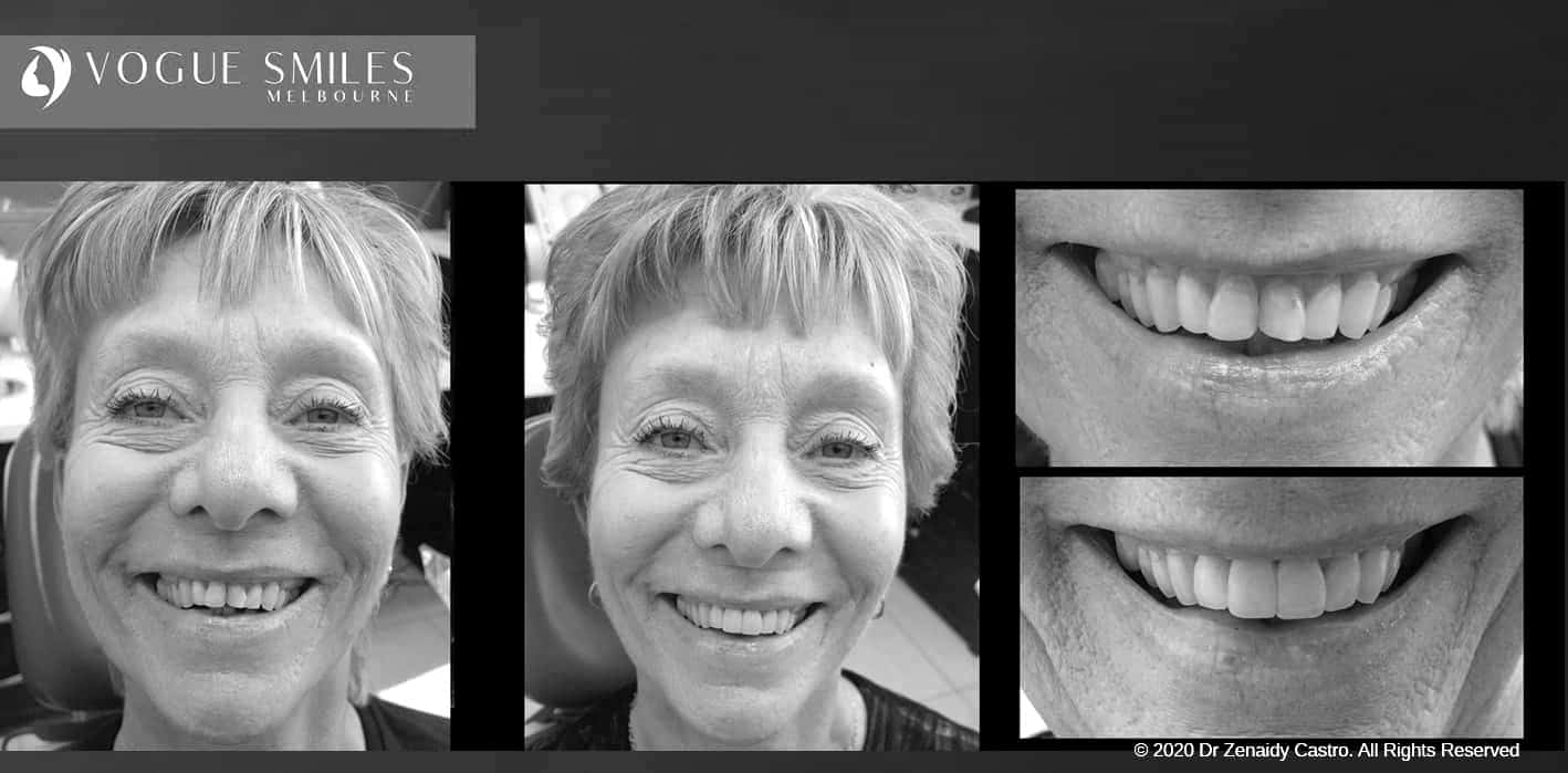 Composite Veneers - Resin Bonding- Teeth Teeth Veneers Melbourne -VOGUE SMILES MELBOURNE Composite Veneers - Resin Bonding- Teeth Teeth Veneers Melbourne -VOGUE SMILES MELBOURNE