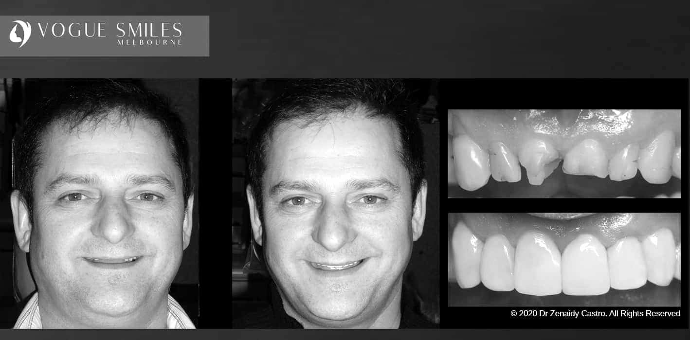 Composite Veneers - Resin Bonding- Teeth Teeth Veneers Melbourne -VOGUE SMILES MELBOURNE Composite Veneers - Resin Bonding- Teeth Teeth Veneers Melbourne -VOGUE SMILES MELBOURNE (19)