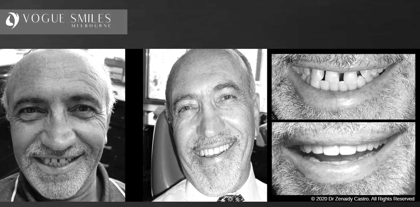 Composite Veneers | Resin Bonding Teeth | Teeth Veneers Melbourne Composite Veneers | Resin Bonding Teeth | Teeth Veneers Melbourne
